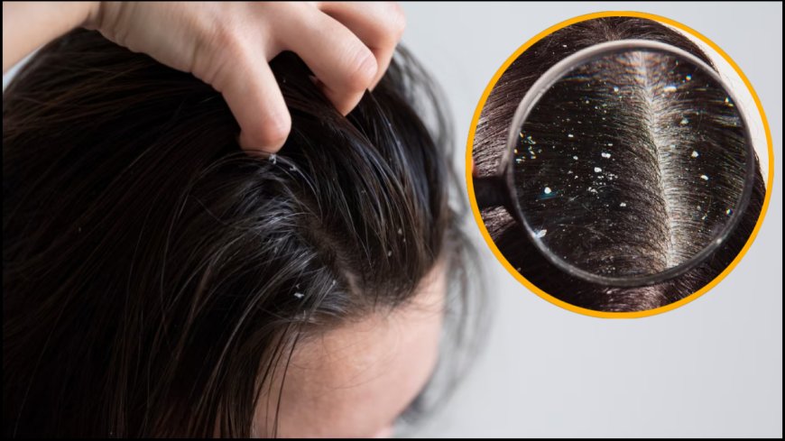 ठंड आते ही सिर में बढ़ गई है खुजली की समस्या, ये 5 रुपए की चीज रूसी Dandruff का कर देगी पक्का इलाज